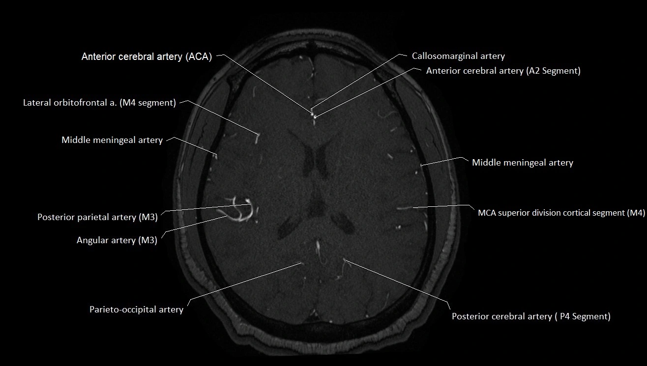 MRA brain (cerebral arteries) anatomy axial 3T image 35.webp